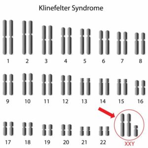 Chromosomenpaare beim Klinefelter-Syndrom